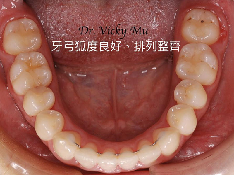 儿童牙齿根管治疗影响换牙吗组图