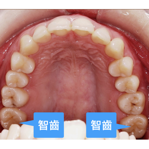 矯正治療中，智齒能不能取代大臼齒這個大哉問