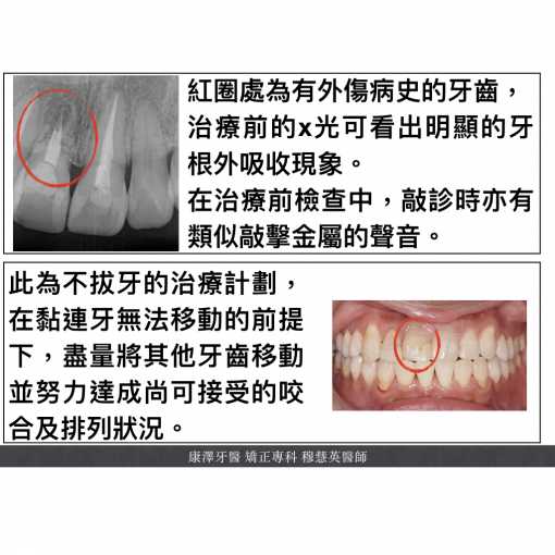 拉不動的牙（黏連牙 tooth ankylosis）：成因、診斷與矯正考量