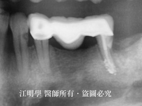 牙周手術案例